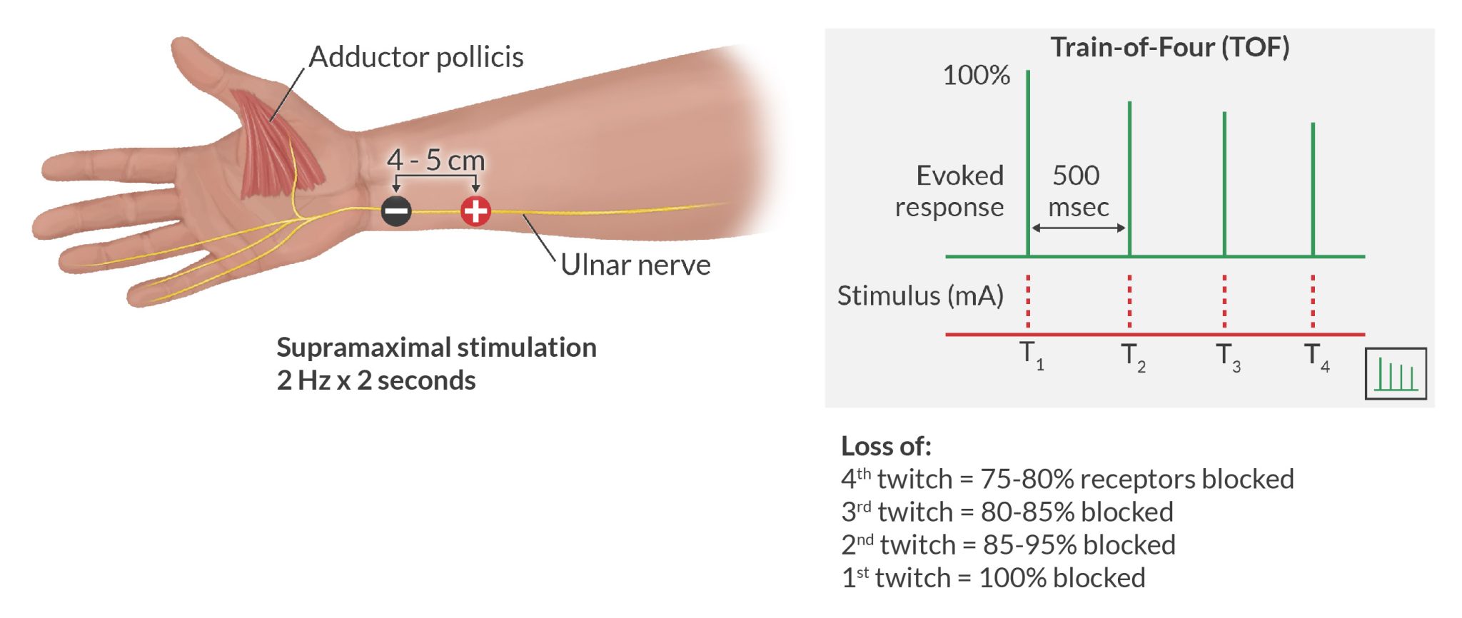 Using Train-of-Four Monitoring For Anesthesia Recovery